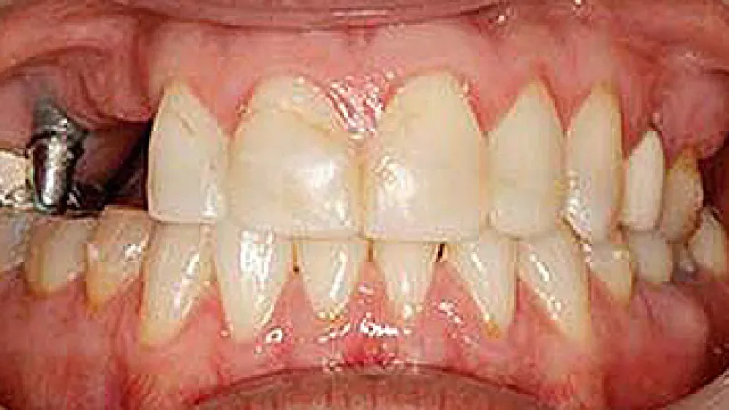 Close-up of human teeth showing dental metal filling and gum inflammation around lower teeth.