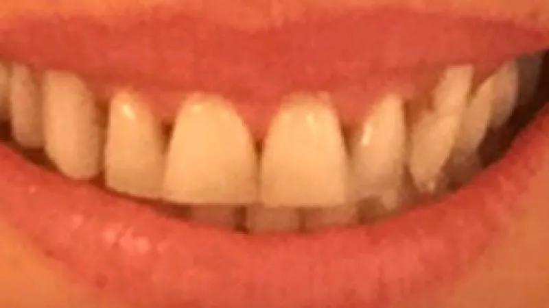 Close-up of a smiling mouth showing slightly uneven front teeth and healthy pink lips.