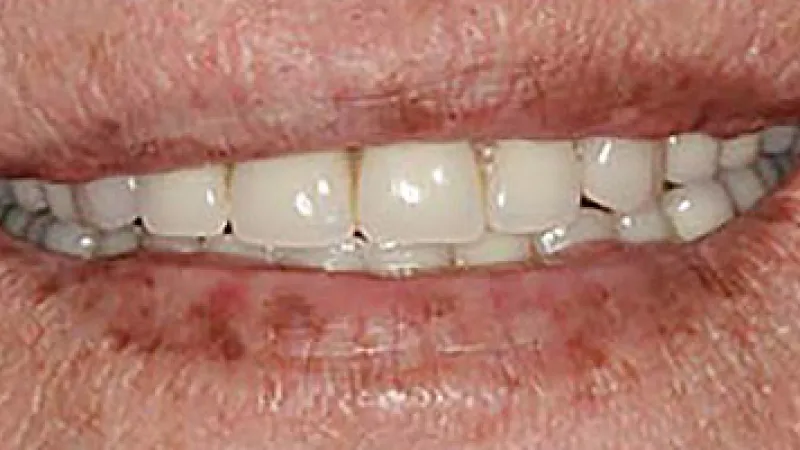 Close-up of smiling lips showing white teeth and aged skin with visible wrinkles and spots.