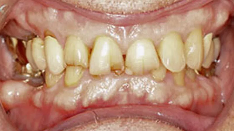 Close-up of a person's mouth with yellowed, crooked teeth and dental decay visible.