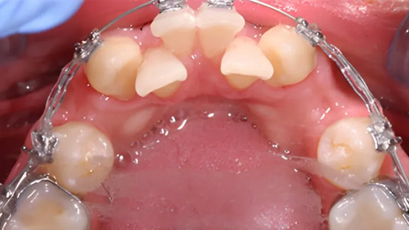 Close-up view of upper teeth with metal braces and wire orthodontic treatment inside mouth.