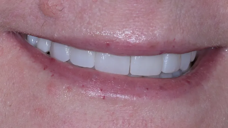 Close-up of a smiling mouth showing clean white teeth and slightly dry lips with minor blemishes.