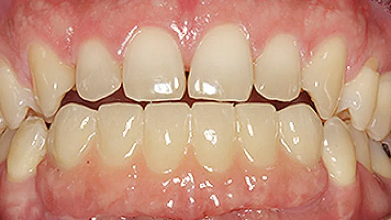 Close-up of human teeth with visible gaps and slight misalignment between upper and lower front teeth.