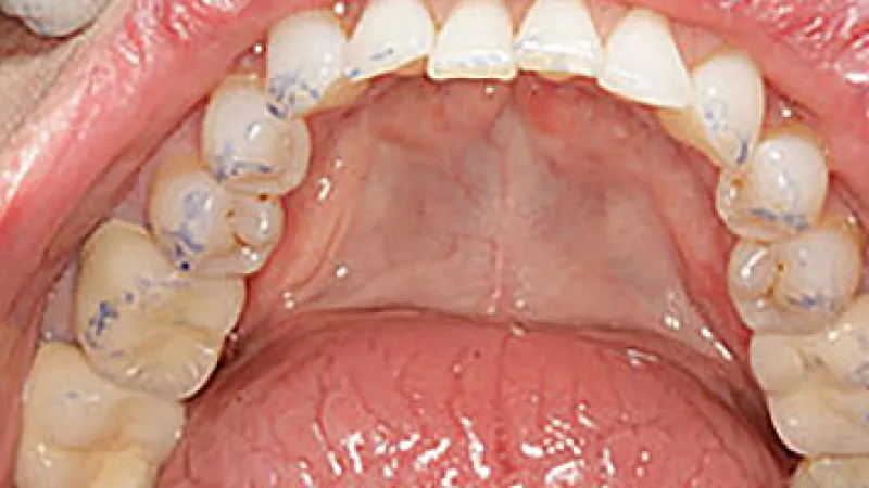 Close-up of upper teeth and palate with dental plaque disclosing agent highlighting plaque areas in blue.