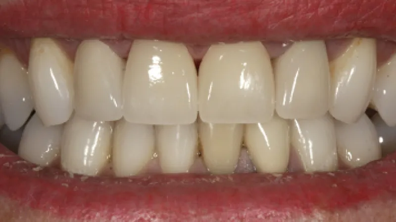 Close-up of a smile showing upper and lower teeth with slight discoloration and natural texture