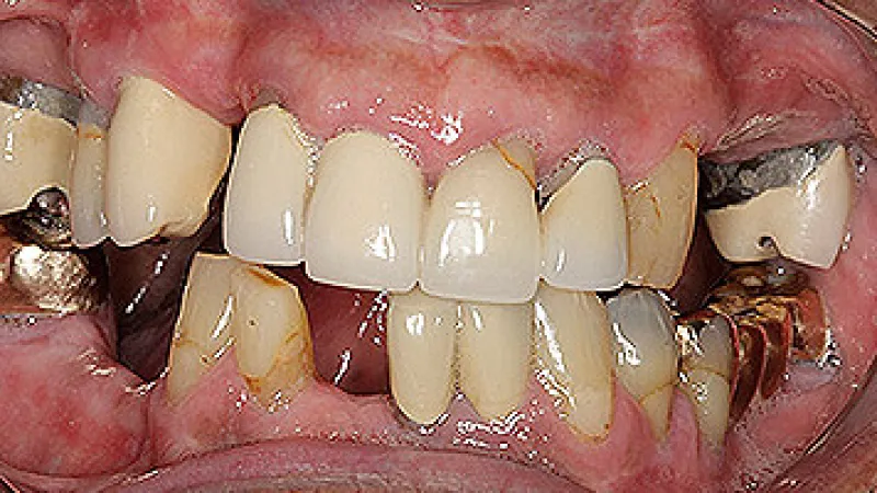 Close-up of damaged, decayed, and metal-crowned teeth with visible dental issues and gum inflammation.
