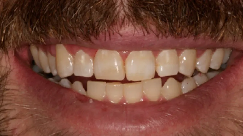 Close-up of a smiling person's mouth showing natural, healthy teeth with slight gaps and facial hair.