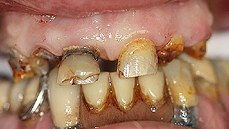Close-up of severely decayed, cracked, and discolored teeth with visible gum disease and dental damage.