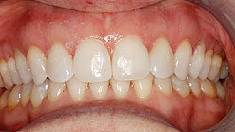 Close-up of healthy white teeth and pink gums with slight yellowing near the molars and clean dental alignment.