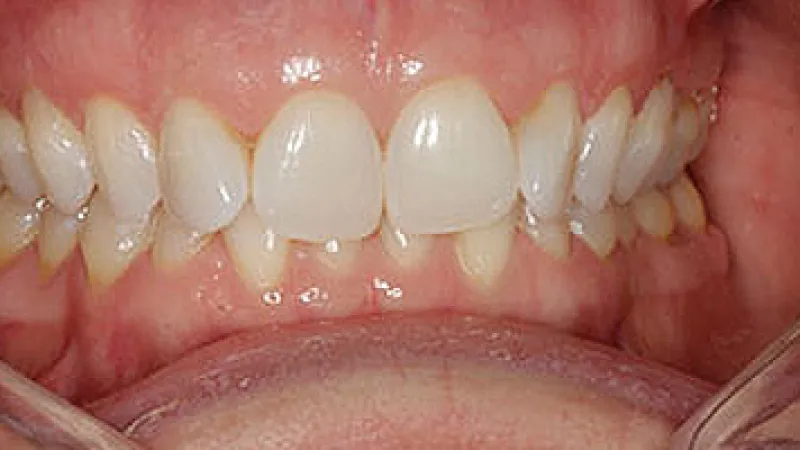 Close-up of human teeth showing gum health and alignment with partially open mouth and visible dental row