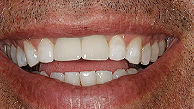 Close-up of an adult male smiling showing teeth with natural texture and facial hair details.