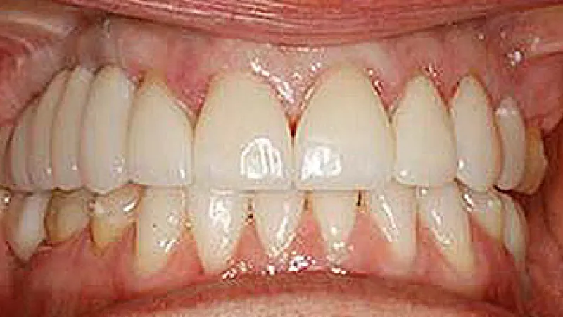 Close-up of human teeth showing dental crowns and natural teeth with healthy gums and slight discoloration.