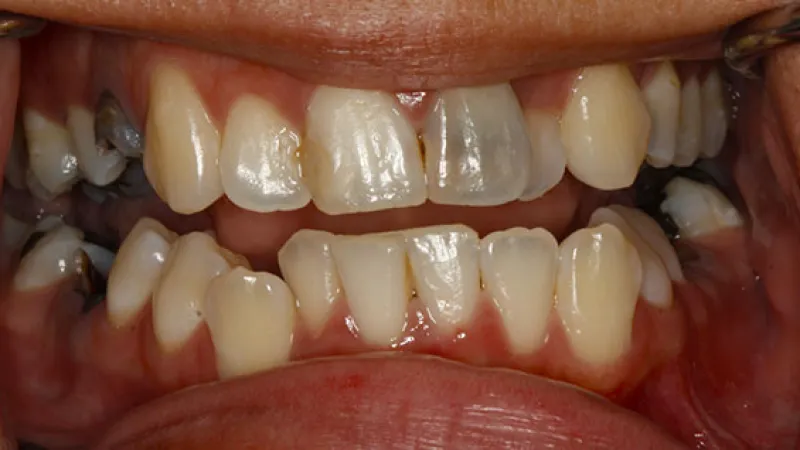 Close-up of uneven, stained teeth with visible plaque and gum inflammation in the lower jaw.