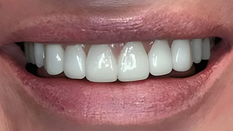Close-up of a smiling mouth showing bright, even, and healthy white teeth and pink lips.