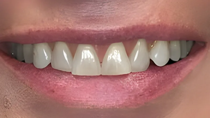 Close-up of a smile showing white teeth with a slight gap between front teeth and natural pink lips