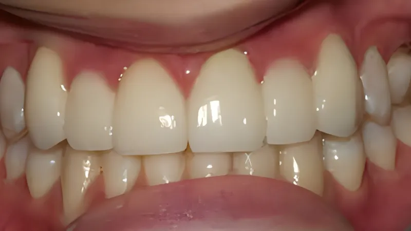 Close-up of healthy, clean human teeth and gums with natural color and alignment under bright light.