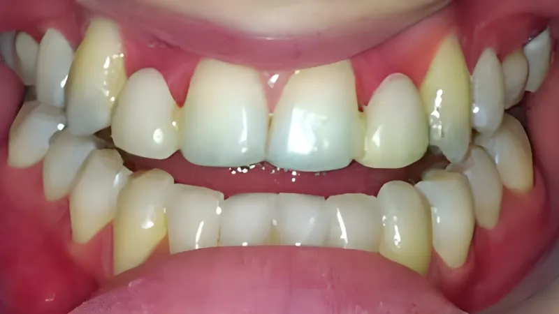 Close-up of misaligned and stained upper and lower teeth with visible gaps and discoloration.