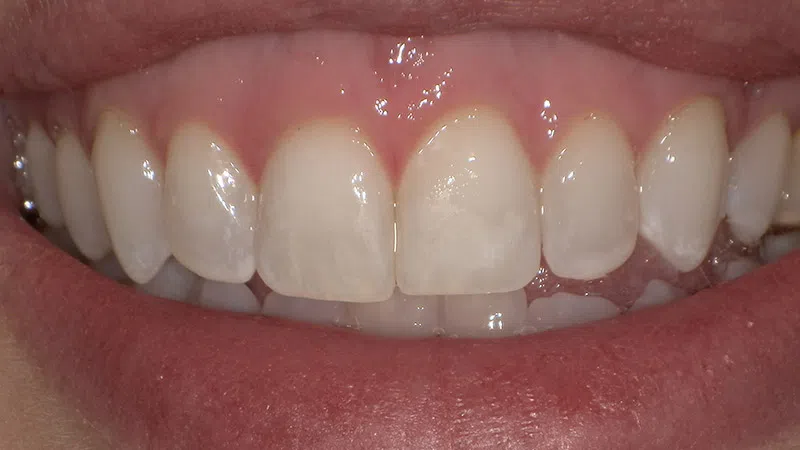Close-up of a smiling mouth showing clean, white upper front teeth and pink gums.