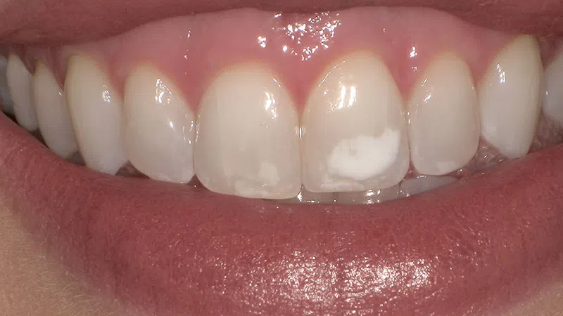 Close-up of a smile showing teeth with white spots and healthy pink gums.