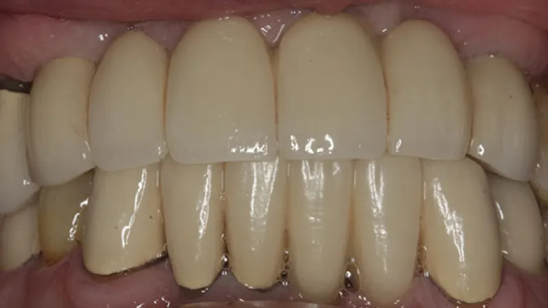 Close-up of upper and lower artificial dental crowns showing realistic tooth restoration and color variations.