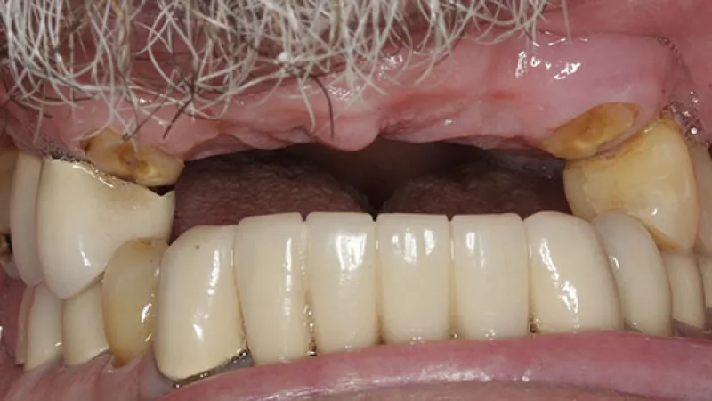 Close-up of upper and lower teeth showing worn natural teeth and dental crowns with missing gaps.