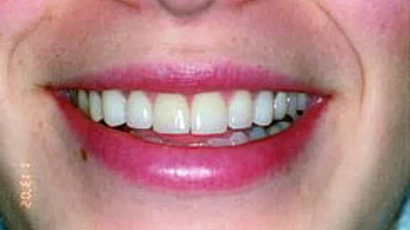 Close-up of a smiling person showing white teeth and pink lips with a small mole below the lip.