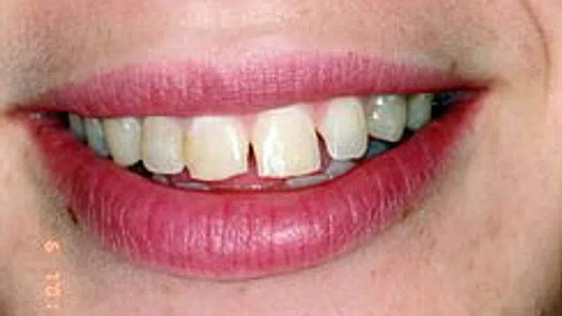 Close-up of a smile showing misaligned and slightly yellowed teeth with lips in natural pink tone.