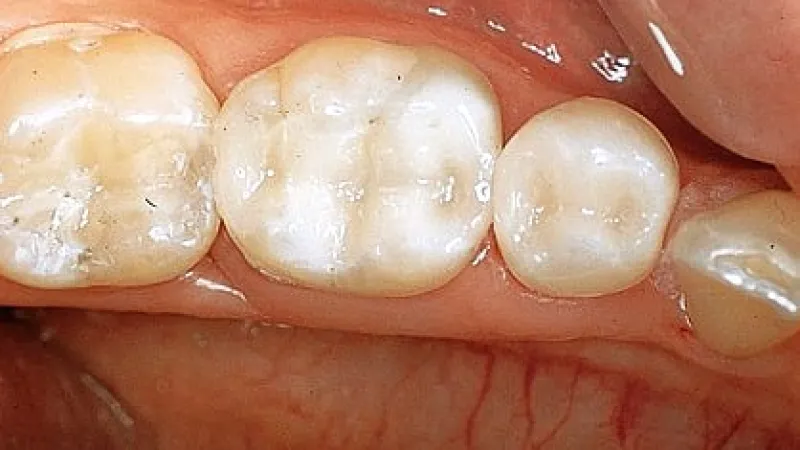 Close-up view of clean, healthy molar teeth and gums inside a human mouth with natural color and texture.
