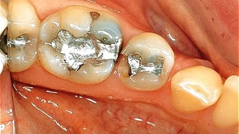Close-up of molars with silver dental fillings in lower jaw inside mouth showing dental restoration.