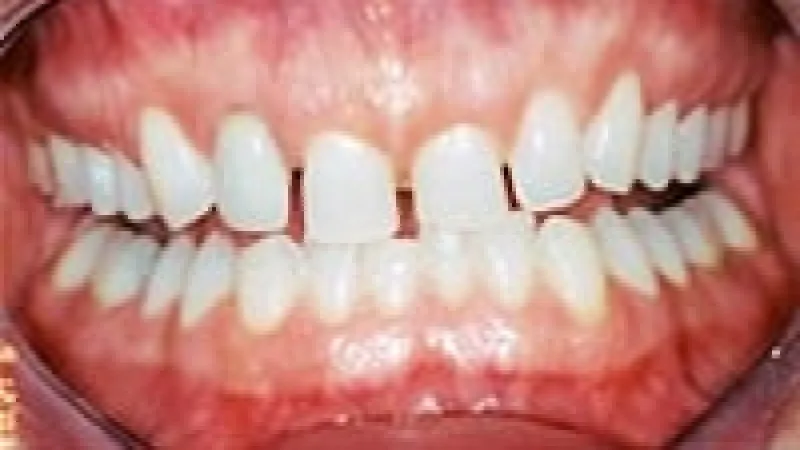 Close-up of human teeth showing dental spacing and gum texture in the open mouth.
