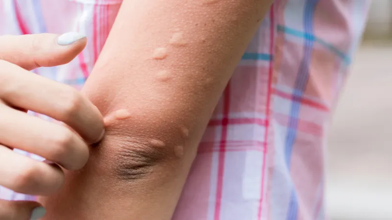 Nine Reasons Why Mosquitoes Love You