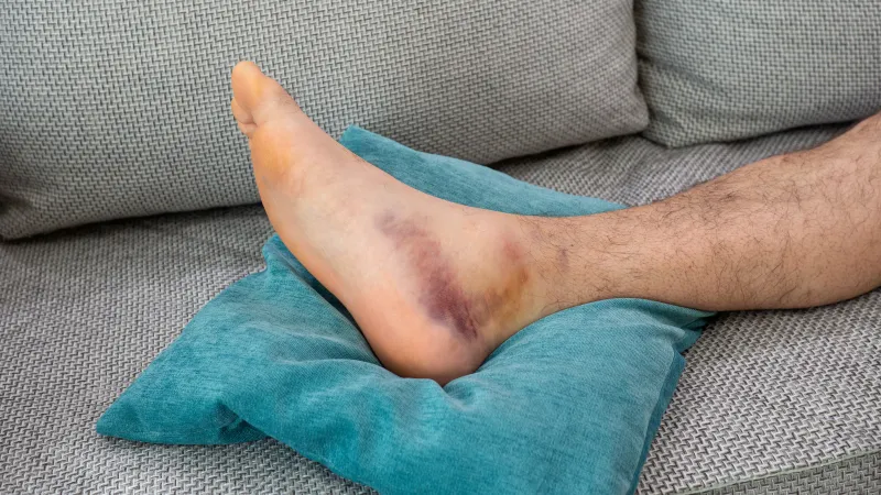 Injured foot with large purple bruise resting on a blue cushion on a gray couch fabric.