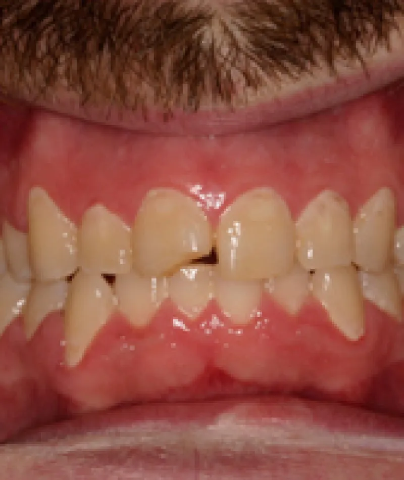 Close-up of a man's mouth showing crooked, yellowed teeth with dental cheek retractors in place