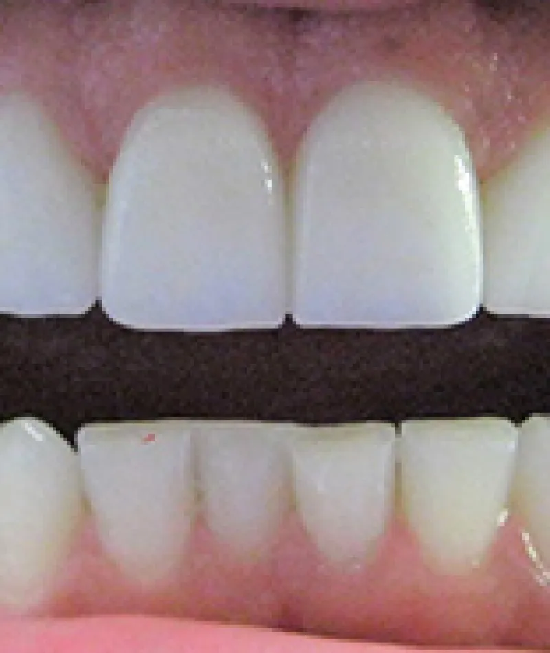 Smile Gallery Tampa, FL | Doering Family Dental | Doering Family Dental