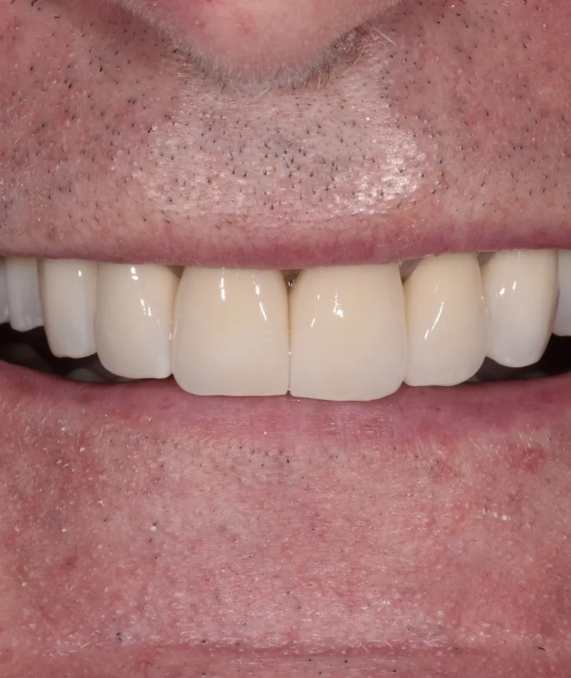 Close-up of a man's mouth showing dental veneers or crowns on upper front teeth.