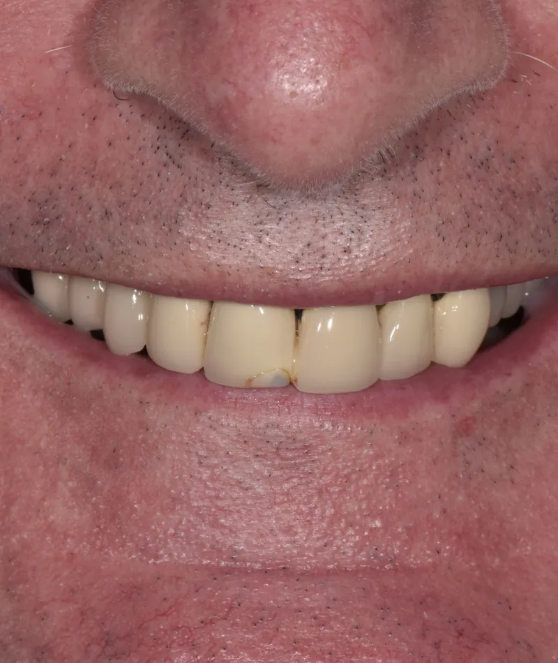 Close-up of a man's smile showing stained and chipped dental veneers on front teeth.