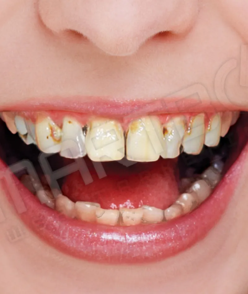 a person's mouth with teeth and tongue sticking out