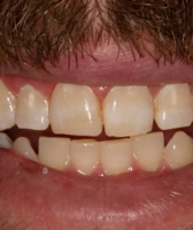 Close-up of a smiling person's mouth showing natural, healthy teeth with slight gaps and facial hair.