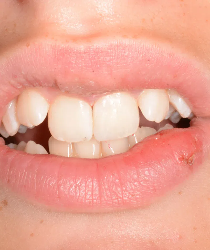 Close-up of a mouth with teeth showing and a cold sore on the lower lip of a person with fair skin.
