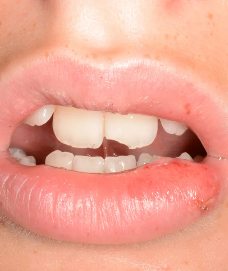 Close-up of lips with a small cold sore on the lower lip and slightly parted teeth.
