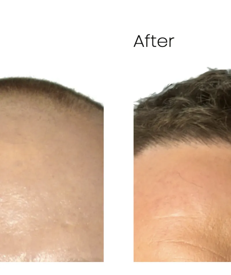 Hair Transplant