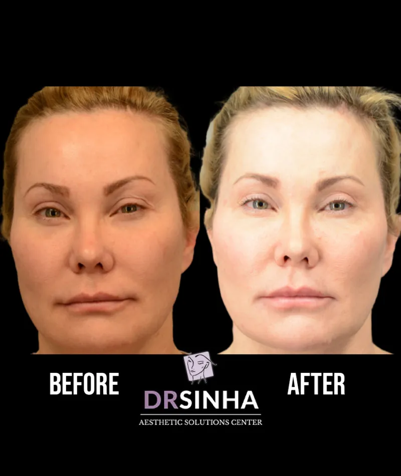 Best Chin Liposuction & Tightening Before & After Case Study 1