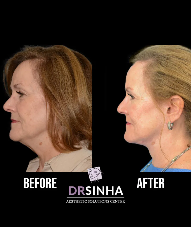 Best Necklift Case Study 2 Facial Aesthetic Surgery