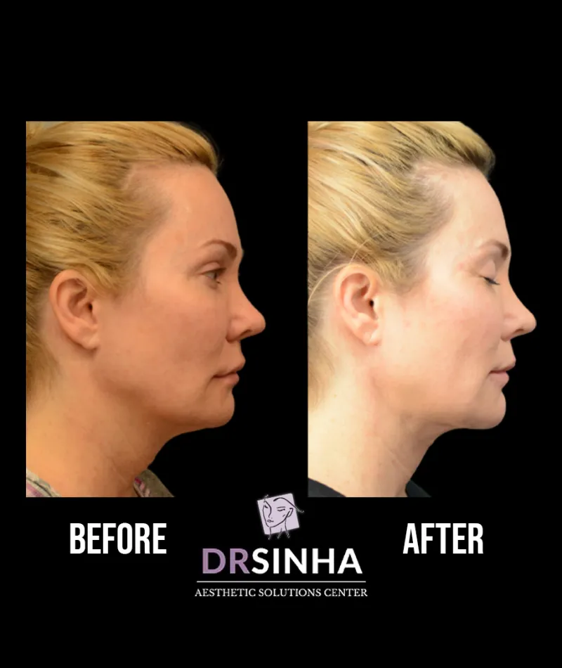 Best Chin Liposuction & Tightening Before & After Case Study 2