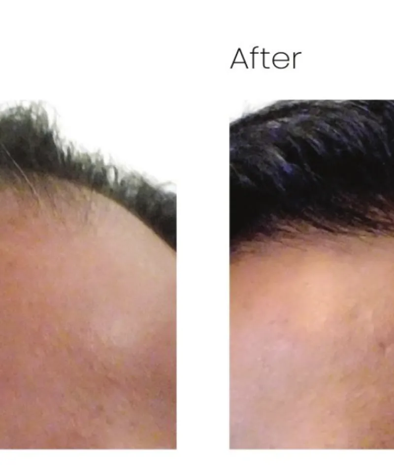 Atlana Hair Transplant