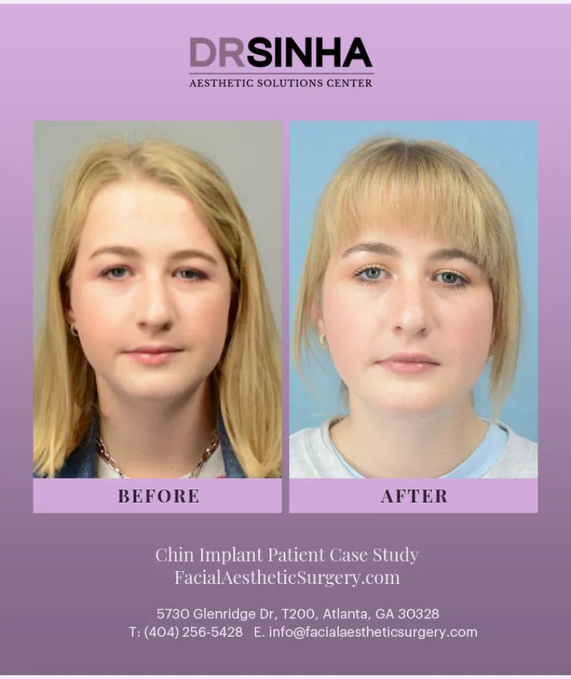 Best Chin Implant Atlanta Case Study 1  Facial Aesthetic Surgery