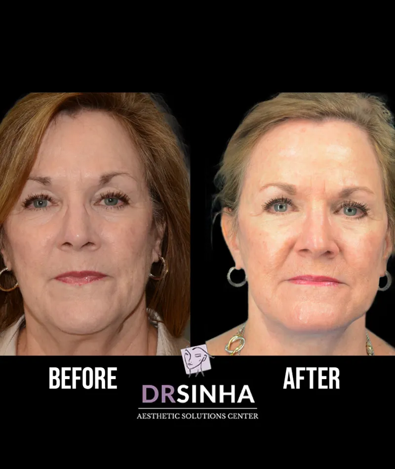 Best Facelift Atlanta Case Study 1 Facial Aesthetic Surgery