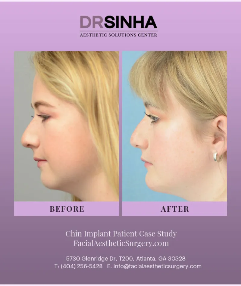 Best Chin Implant Atlanta Case Study 2 Facial Aesthetic Surgery
