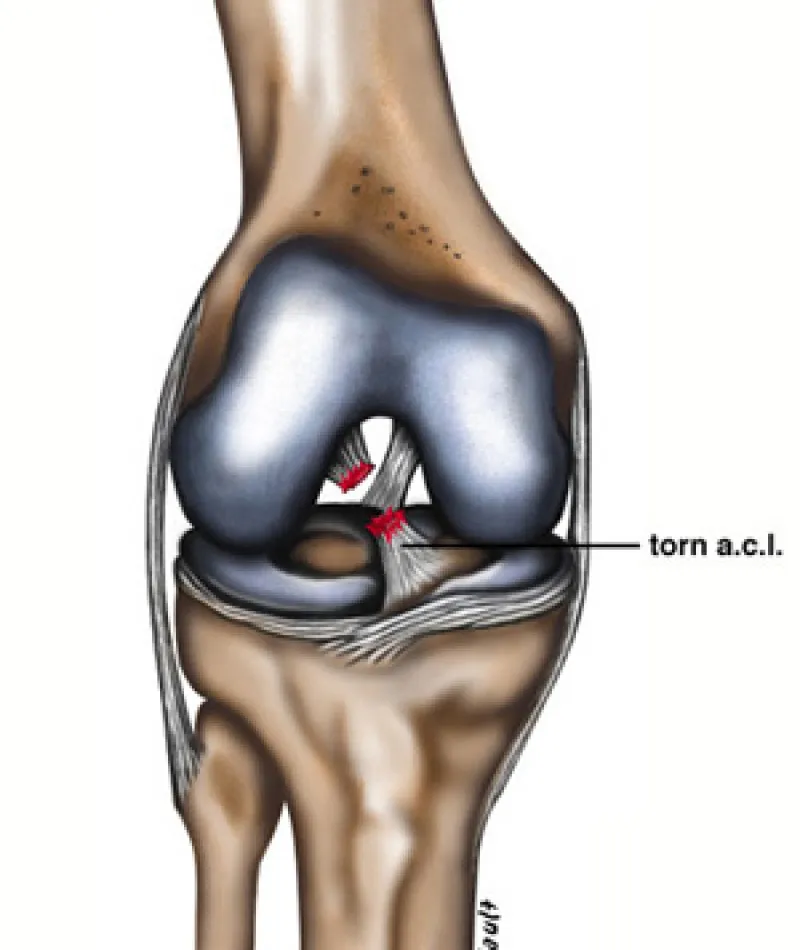 Medical illustration of a knee joint showing a torn anterior cruciate ligament (ACL) injury.