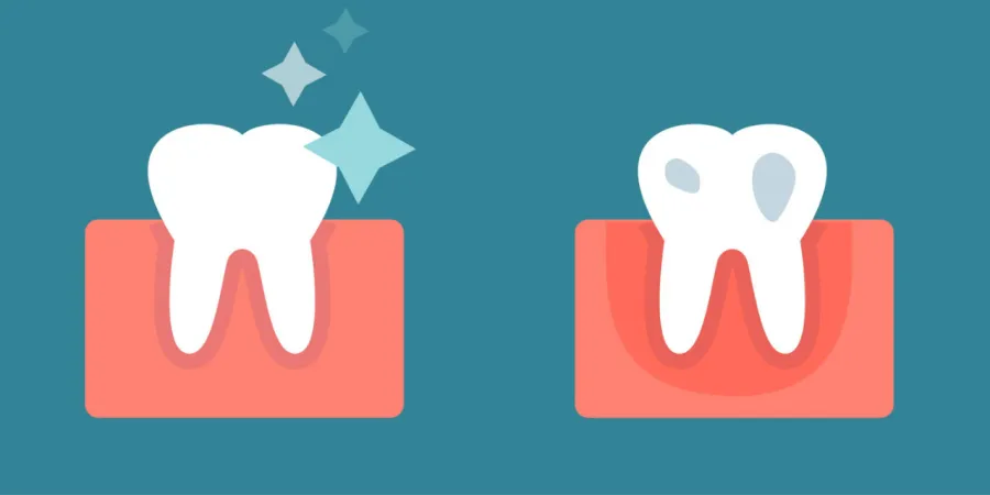 diagram of pockets around teeth